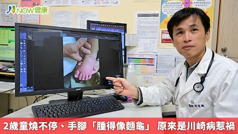2歲童燒不停、手腳「腫得像麵龜」 原來是川崎病惹禍