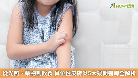 從光照、藥物到飲食 異位性皮膚炎5大疑問醫師全解析