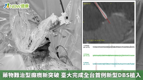 藥物難治型癲癇新突破 臺大完成全台首例新型DBS植入  