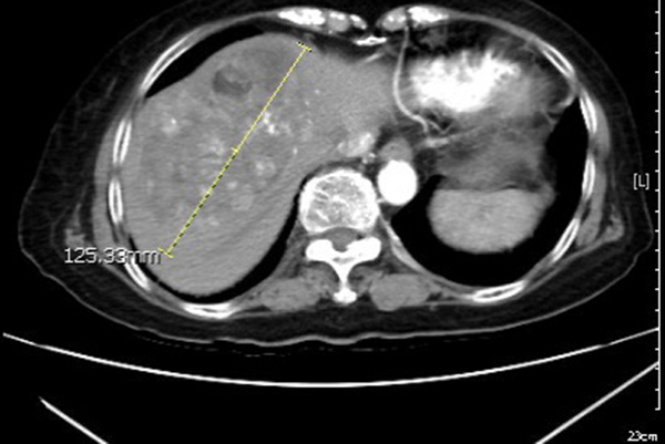 12公分肝腫瘤之電腦斷層影像