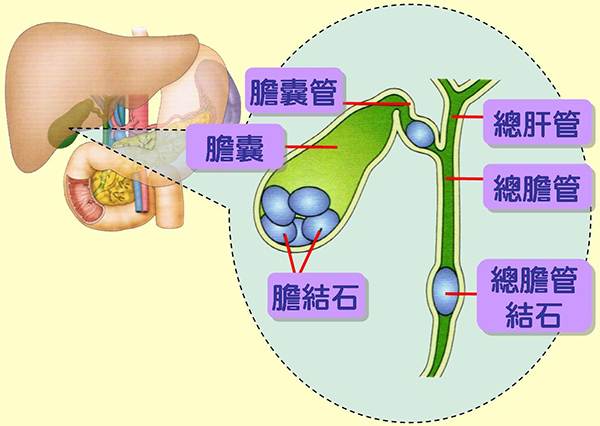 膽結石