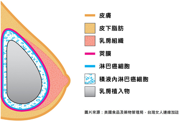 乳房植入物