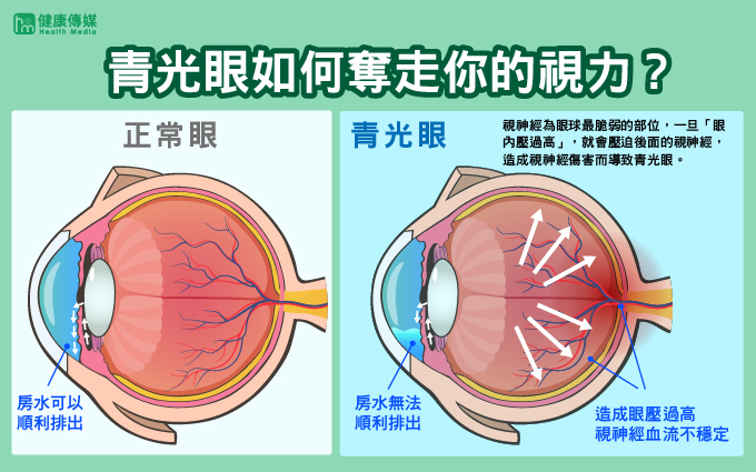 青光眼