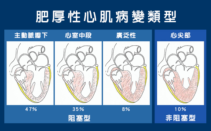 肥厚性心肌病變類型