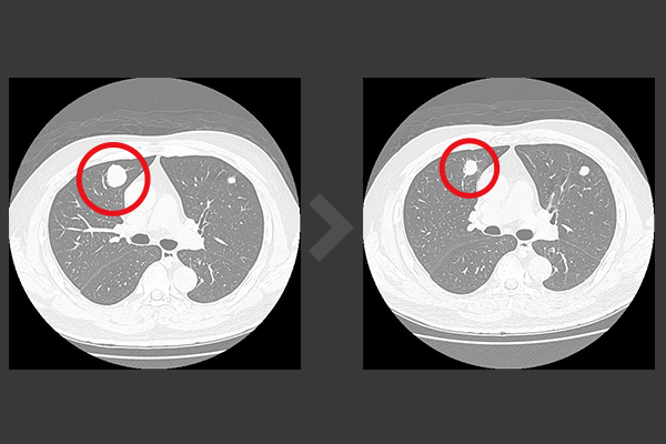 肝癌併腦轉移肺轉移患者，接受新一代肝癌標靶藥物樂衛瑪搭配免疫療法後，腫瘤最大一顆從27mm（圖左之左上角），縮小為16mm（圖右之左上角）。（圖／亞洲大學附屬醫院公共事務室提供）