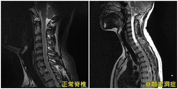 下肢無力走不穩 當心罹患罕病「脊髓空洞症」 正常脊椎與脊髓空洞症的核磁共振影像比較。(圖/亞大醫院提供)