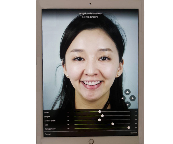 牙齒美容低價競爭 便宜不如專業有保障 AR模擬軟體結合牙科治療,模擬美齒貼片治療後的效果。(圖/陳忠明醫師提供)