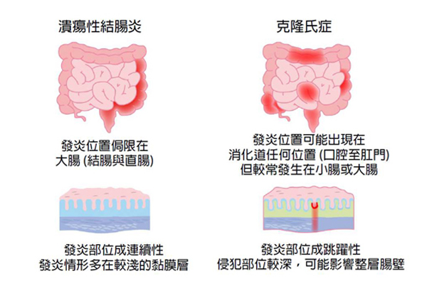 發炎性腸道疾病為腸道免疫系統過度反應與錯誤識別所引起，依發炎分佈型態、侵犯腸壁程度，可分為潰瘍性結腸炎和克隆氏症。（圖／公關照片）