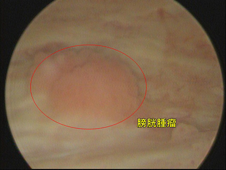 賴爺爺經膀胱鏡檢查,才診斷為膀胱腫瘤。(圖/亞洲大學附屬醫院提供) 賴爺爺經膀胱鏡檢查,才診斷為膀胱腫瘤。(圖/亞洲大學附屬醫院提供)
