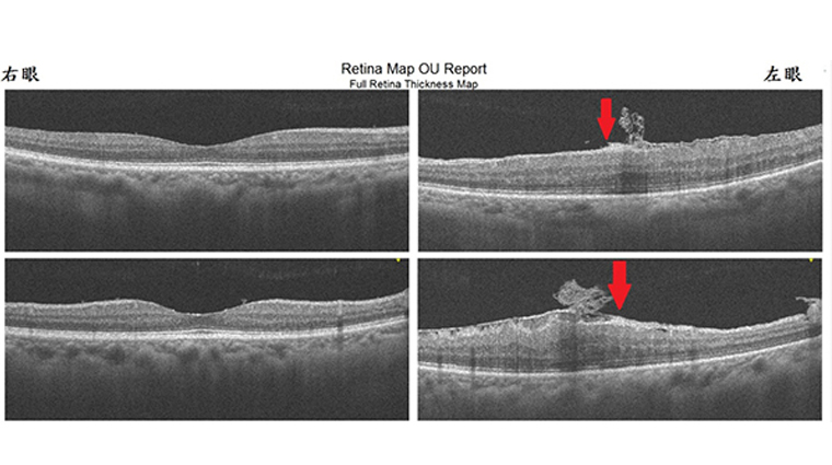 光學同調斷層掃描儀（OCT）檢查下，相對於右眼正常的黃斑部，左眼可見到黃斑部表面多了一層纖維增生膜（紅色箭頭）。（圖／王元聖醫師提供）