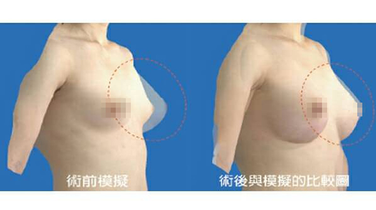 張大力醫師登ISAPS 微創隆乳與全球整形權威對話 經VECTRA 3D術前影像模擬系統模擬出來的隆乳術前及術後比較圖。(圖/東京風采整形外科診所提供)