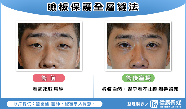 瞼板保護全層縫法