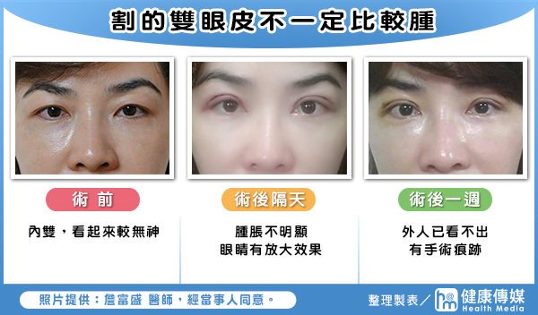 割的雙眼皮不一定比較腫
